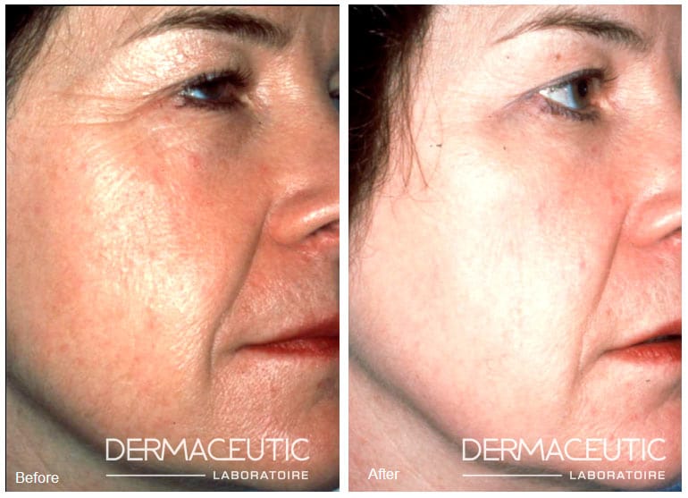 cosmo-peel-18 Dermaceutic | Productos profesionales - Cosmo Peel 18%